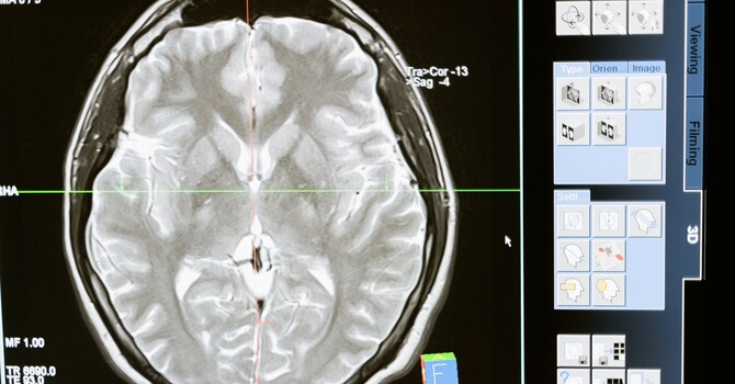 MRI Findings Don’t Always Equal Pain image